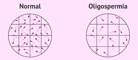 Олигоспермия